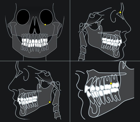 Romexis 3D 세팔로 분석 본사 제품 이미지