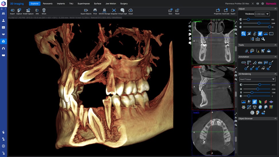 Romexis 3D 영상 본사 제품 이미지