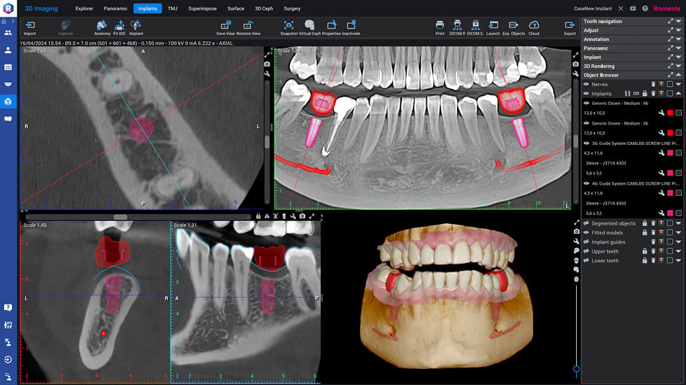 Romexis 3D 임플란트 계획 본사 제품 이미지