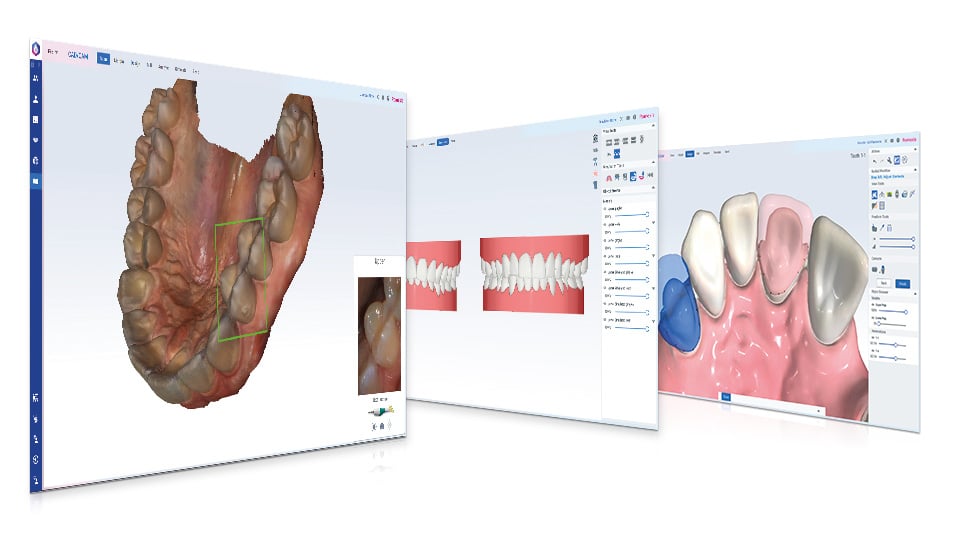 Romexis CAD/CAM 구강 스캔 본사 제품 이미지